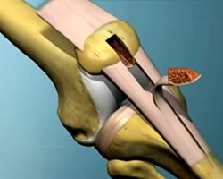 Animation of ACL Reconstruction
