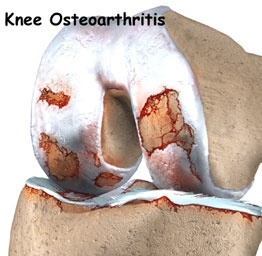Arthritic Knee