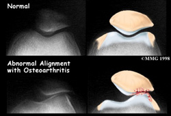 Patella with normal and abnormal alignment