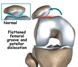 Patellofemoral Instability and Anterior Knee Pain | Kirk Mendez, M.D ...